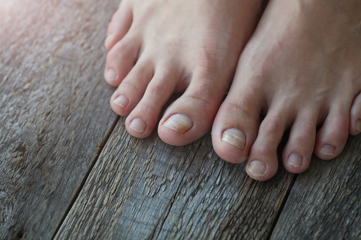 Nail Fungus & Its Symptoms