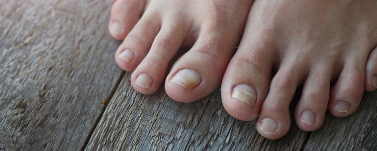 Nail Fungus & Its Symptoms