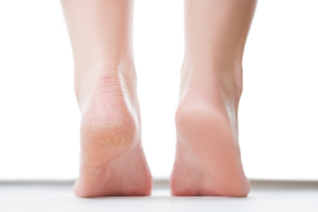 Treating and Repairing Dry Feet and Heels