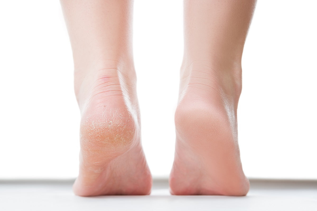Treating and Repairing Dry Feet and Heels
