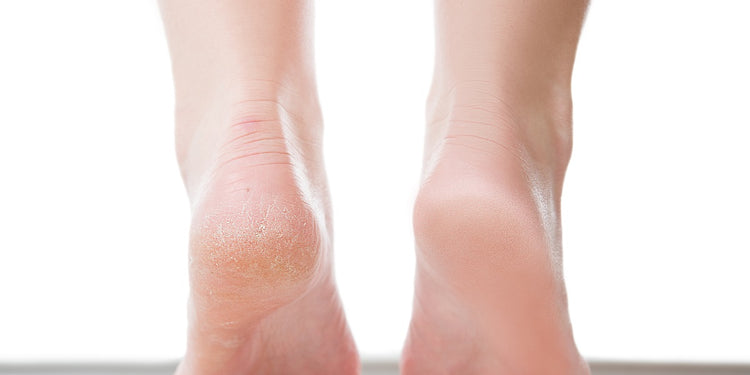 Soaking on sale cracked feet