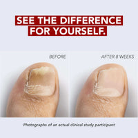 Kerasal Fungal Nail Renewal