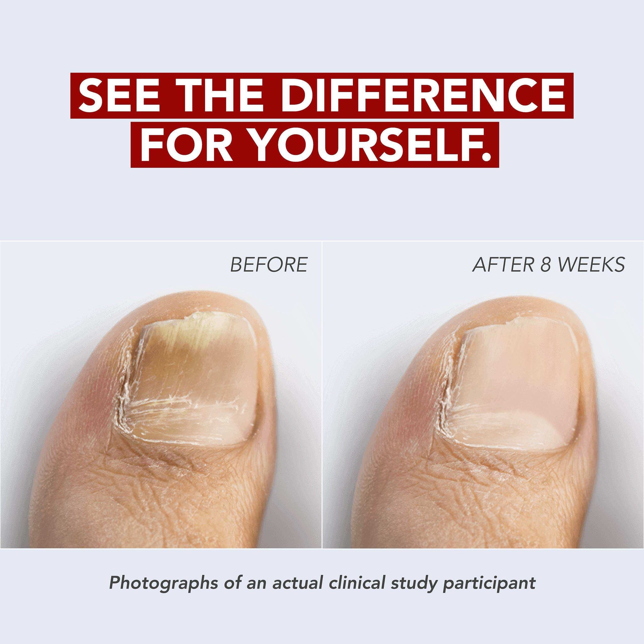Kerasal Fungal Nail Renewal